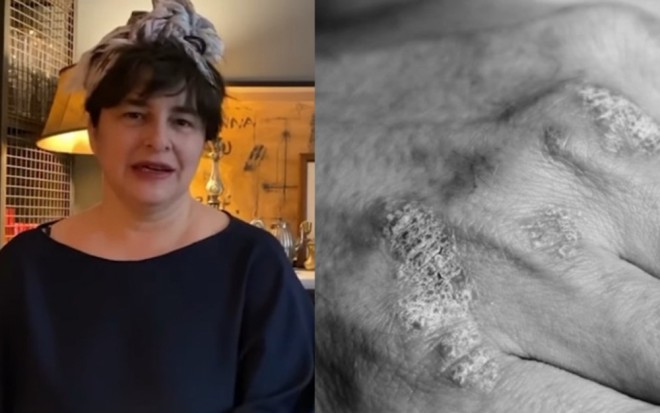 Aktrisa xəstəlikdən əziyyət çəkir - foto