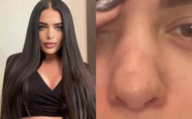 Anastasia ın burnu "çürüyür" - foto